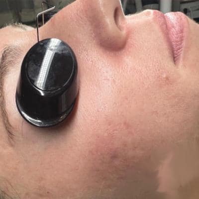 ACNE TREATMENTS
